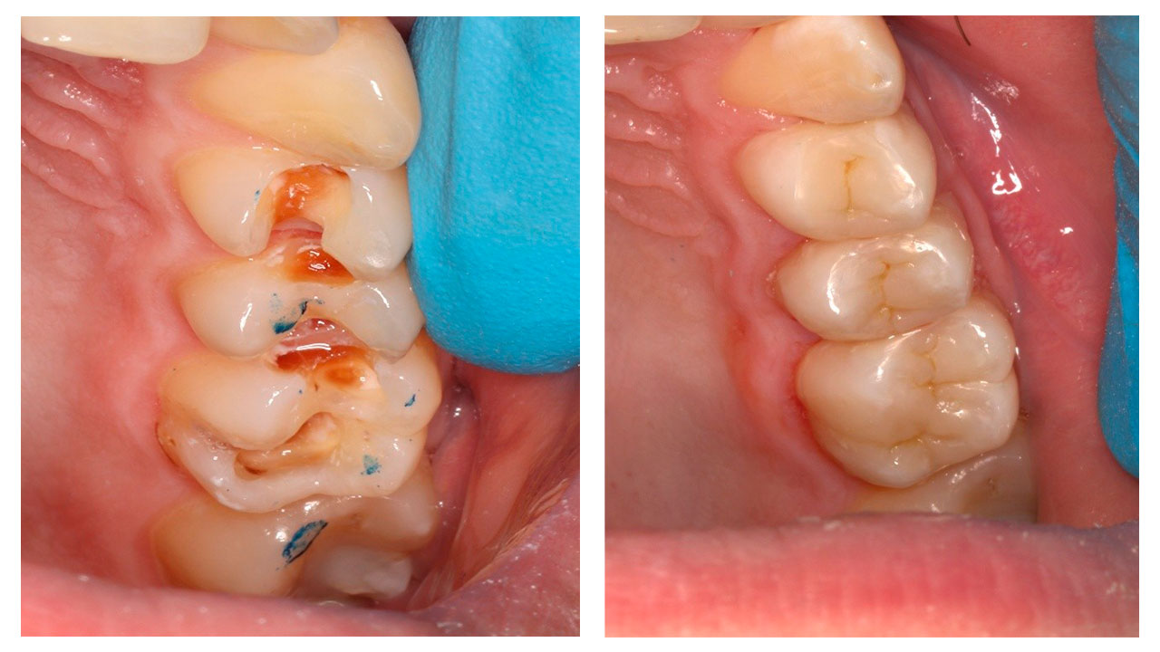 Лікування під мікроскопом