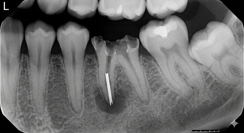 Вилучення уламка инструмента