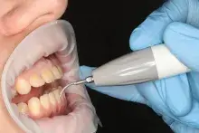 Ультрозвукова чистка