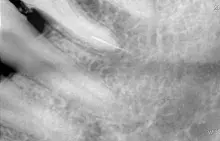 Вилучення уламка инструмента